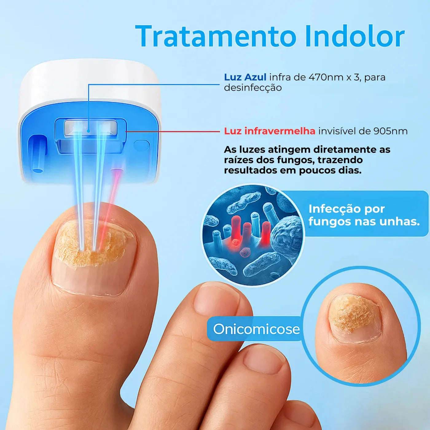 LumiNail Pro - Solução para Fungos nas unhas